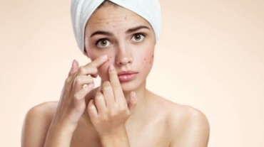 maneras de deshacerse del acné