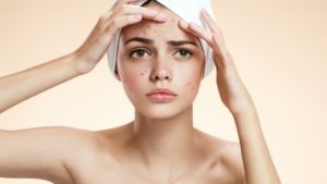 Know why blackheads appear on your forehead and how to prevent them.