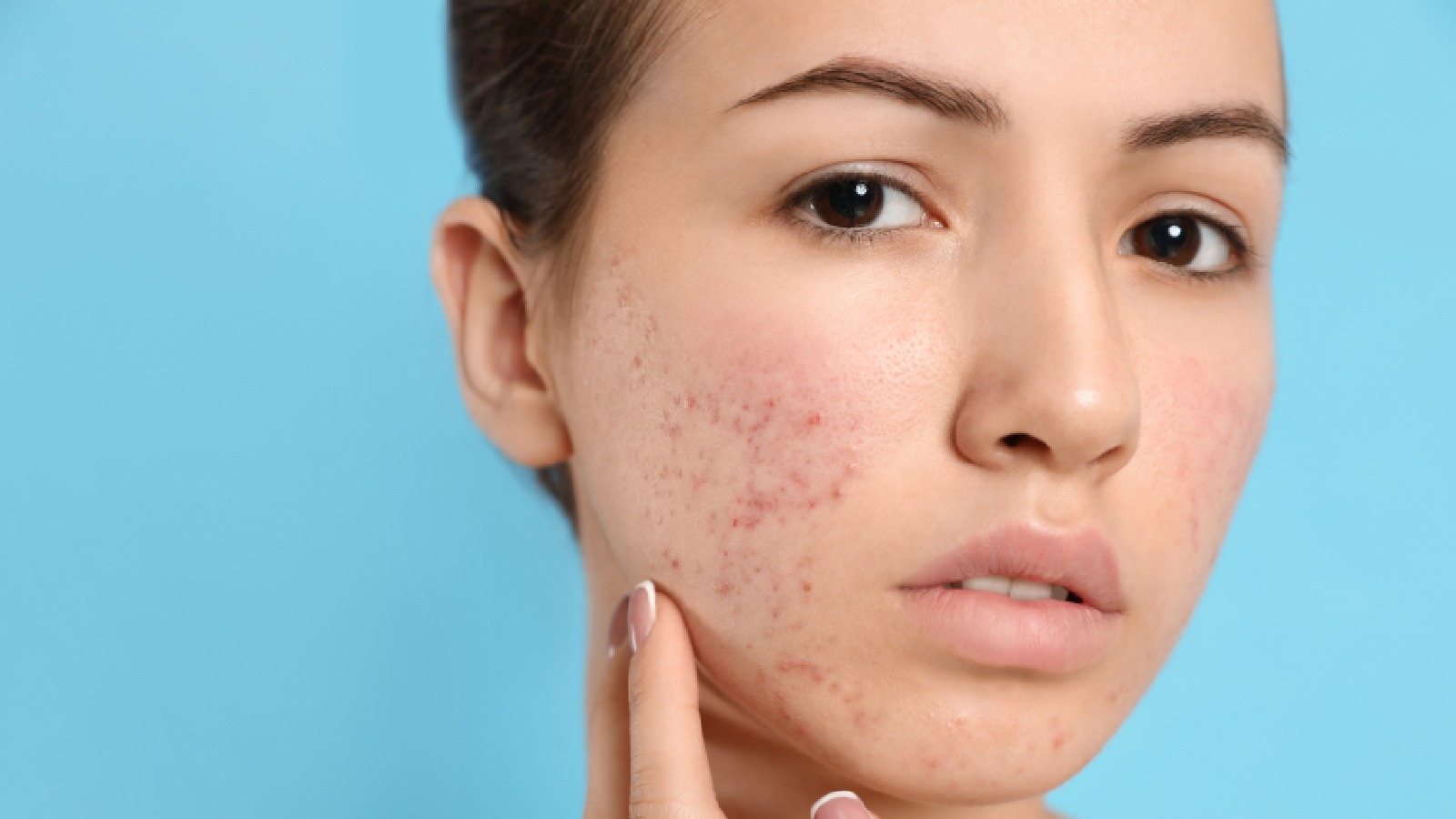 Estrogen also increases acne and other skin problems. Know how to fix them.