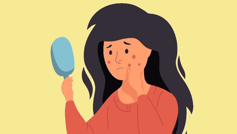These 5 home remedies helped cure my uncontrollable hormonal acne