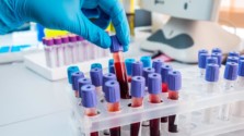 Study suggests that blood test can predict severity of covid-19