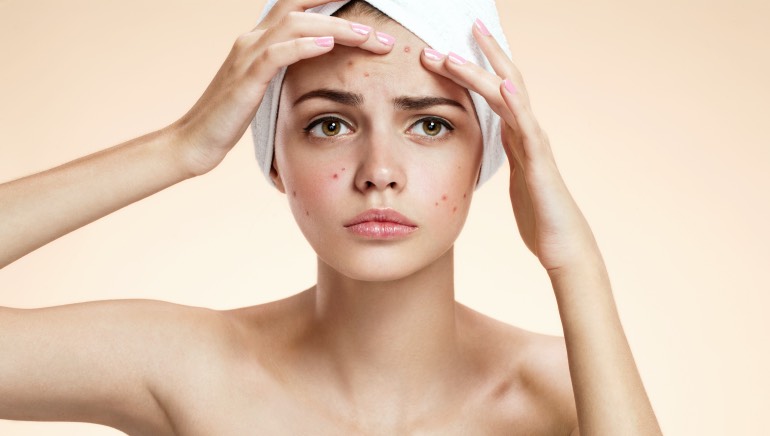 Here are 5 reasons why you should never EVER pop a pimple | HealthShots
