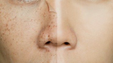 remove freckles